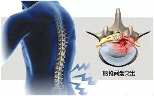 芋頭+紅糖,不出兩周,不僅腰突不見了,坐骨神經也不痛了!