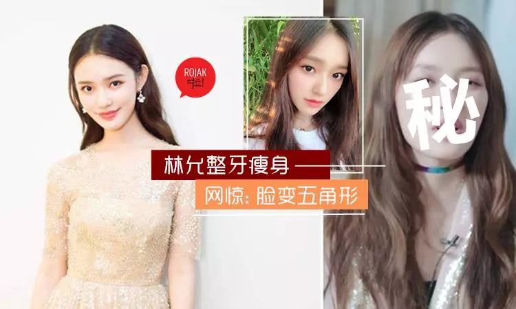 《美人魚》林允去整牙了!瘦了7公斤後臉走形, 顴骨突出令,網友不敢置信:丑到~