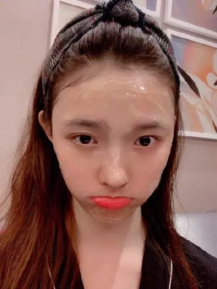 《美人魚》林允去整牙了!瘦了7公斤後臉走形, 顴骨突出令,網友不敢置信:丑到~
