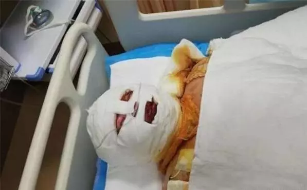 父愛如山!少女遭火吻「全身80%燒傷」,父親偷偷「移植整條左腿皮膚」卻謊稱「在外工作」!