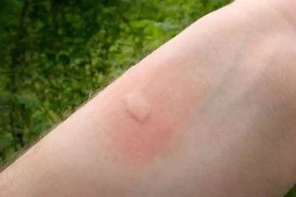 被蚊子叮過總是腫一包又越抓越癢,教你三招止癢方法,60秒後止癢去痕!