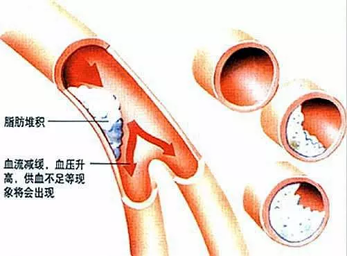 腿上出現這種信號,血脂可能已經很高了