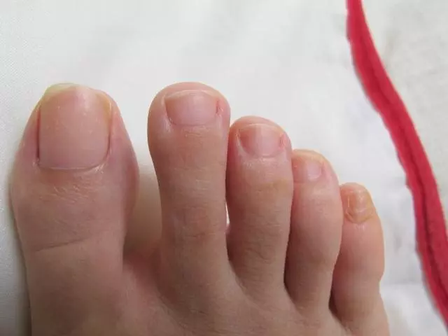 腎臟好或壞,「看腳」就知道!