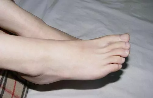 腎臟好或壞,「看腳」就知道!