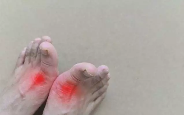 高尿酸「吃」出來,醫生提醒:6種食物不要吃,幫你遠離腎衰竭!