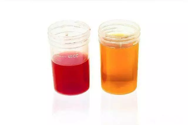 高尿酸「吃」出來,醫生提醒:6種食物不要吃,幫你遠離腎衰竭!