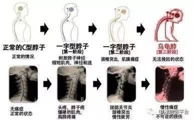 頸椎酸疼難忍,真人指導一個小動作就能治,也可降低血壓