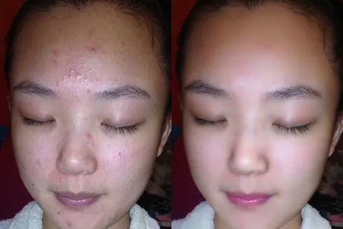 鼻子上擠出「黃粒粒」,是蟎蟲擠在裡面爬,教你兩招,蟎蟲不敢來