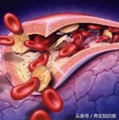 【健康資詢】7個信號說明腦血管堵塞,是腦血栓的前兆,早送醫,或許能救命!