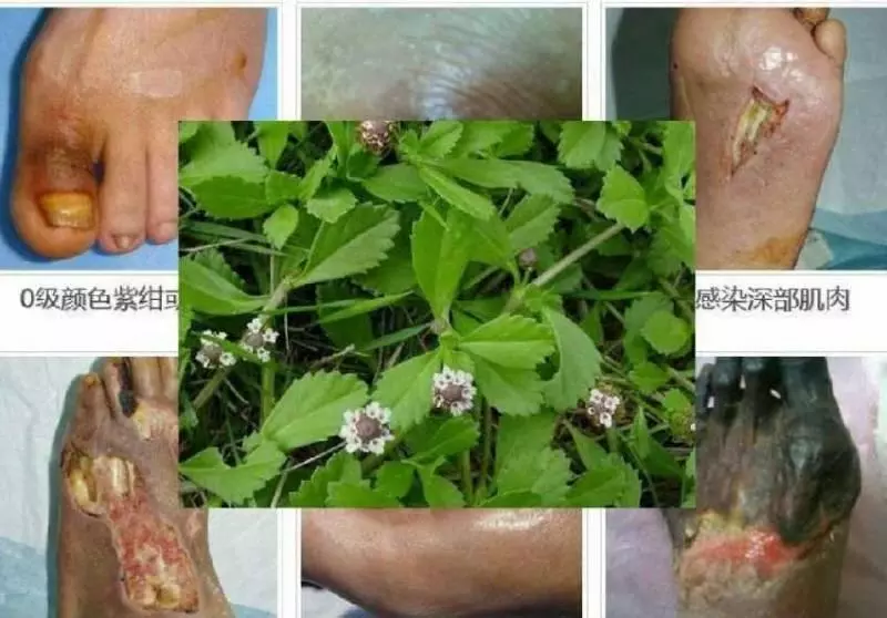 「過江藤」治療糖尿病腳爛效果超強!就算爛腳也治得好,而且傷口也癒合!
