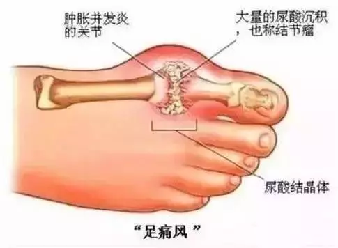 痛風的一個小方子,一天見效,太棒了!