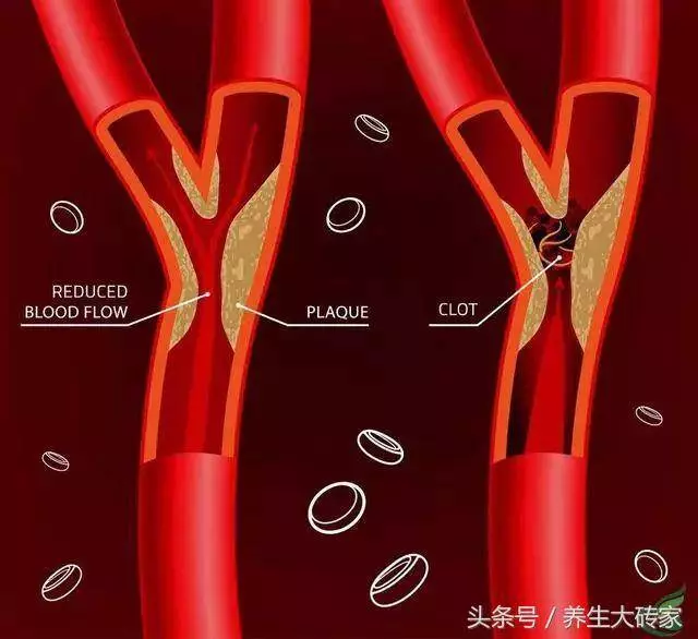 血管老人就老,血管乾淨人不老,簡單三招,通血管、排毒素、更健康!