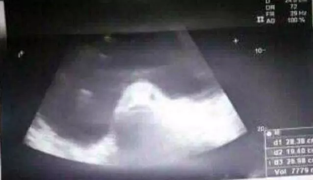 少女肚子異常凸起!家人相信「與魚亂搞」懷孕?