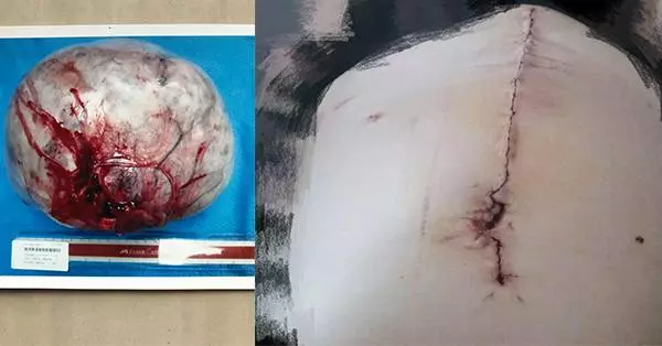 女網友腹部變大,被認為是懷孕了,沒想到竟是血瘤!