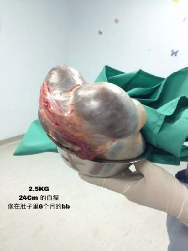 女網友腹部變大,被認為是懷孕了,沒想到竟是血瘤!