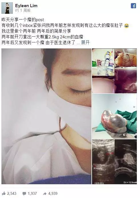 女網友腹部變大,被認為是懷孕了,沒想到竟是血瘤!