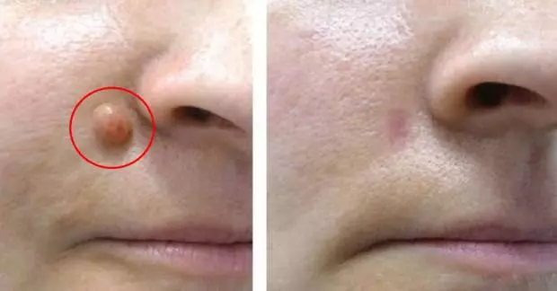 皮膚上長出一顆「小肉瘤」?學會善用一種「天然成分」,不需手術,輕鬆去除!