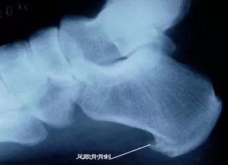 祖傳治骨質增生土方,奶奶二十多年的骨病全靠它治癒!