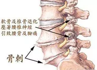 祖傳治骨質增生土方,奶奶二十多年的骨病全靠它治癒!
