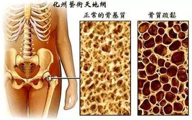 祖傳治骨質增生土方,奶奶二十多年的骨病全靠它治癒!