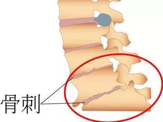 祖傳治骨質增生土方,奶奶二十多年的骨病全靠它治癒!