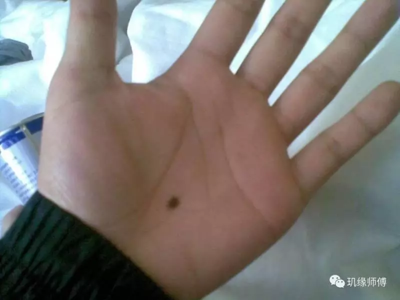 這十處長痣,一生不用愁,這些地方的痣要留著