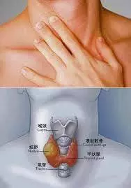 【 大頸泡偏方 】 請幫忙 share 出去,功得無量!