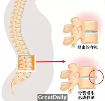 「骨刺獨家藥方」長骨刺免看醫生,喝四天就能止痛!