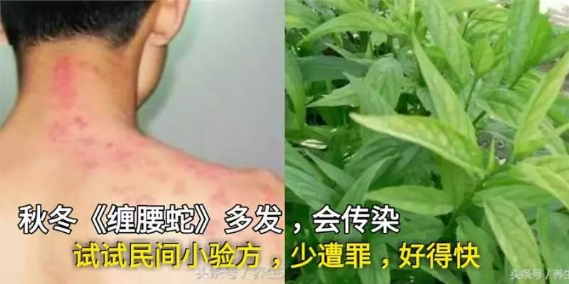 秋冬「纏腰蛇」多發,會傳染,試一試民間小驗方,少遭罪、好得快!