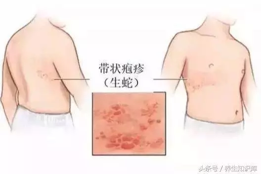 秋冬「纏腰蛇」多發,會傳染,試一試民間小驗方,少遭罪、好得快!
