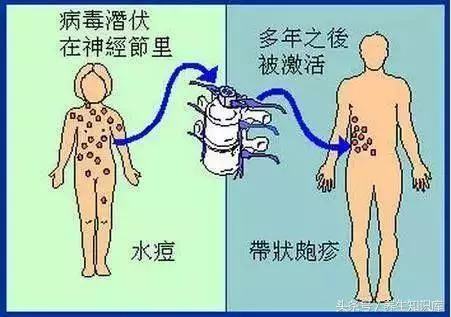 秋冬「纏腰蛇」多發,會傳染,試一試民間小驗方,少遭罪、好得快!