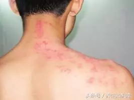 秋冬「纏腰蛇」多發,會傳染,試一試民間小驗方,少遭罪、好得快!