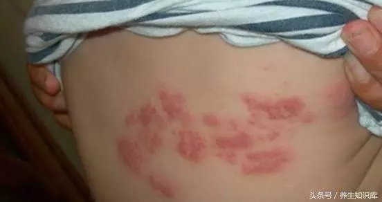 秋冬「纏腰蛇」多發,會傳染,試一試民間小驗方,少遭罪、好得快!