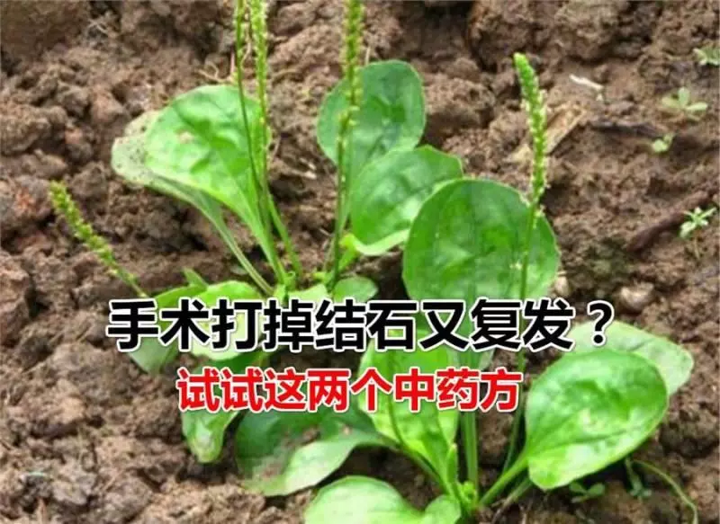 結石患者很痛苦,痛不欲生,不想做手術的可以試試這兩個中藥方 ,效果非常不錯!