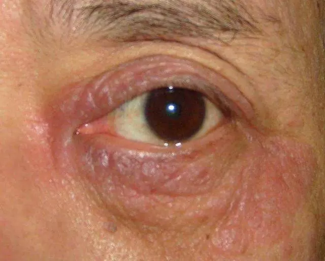 血糖高不高,只需看身體的4個地方就知道,降血糖用4招