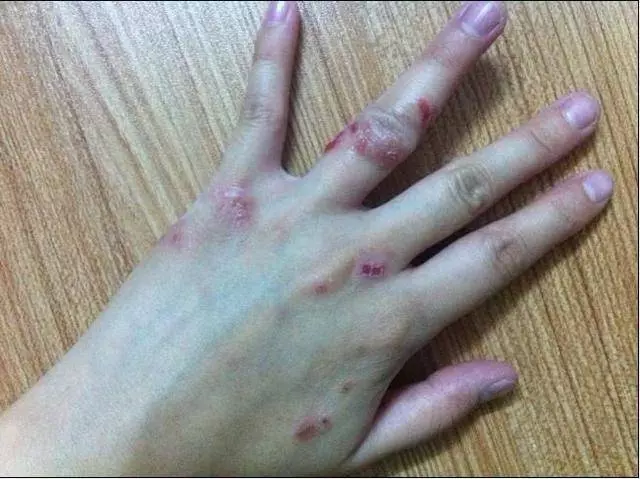 血糖高不高,只需看身體的4個地方就知道,降血糖用4招