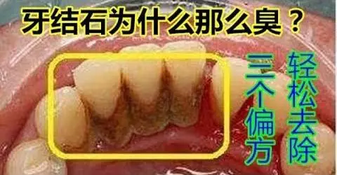 又黃又臭的牙結石太噁心了!3 個偏方輕鬆去除,還你潔白牙齒,和口臭說 bye bye!