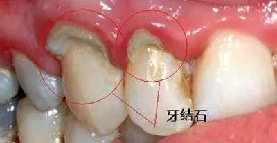 又黃又臭的牙結石太噁心了!3 個偏方輕鬆去除,還你潔白牙齒,和口臭說 bye bye!