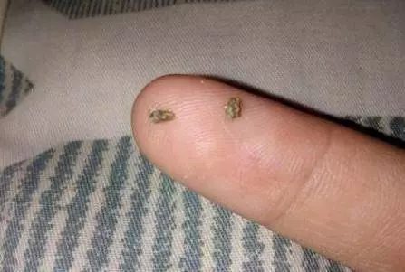 又黃又臭的牙結石太噁心了!3 個偏方輕鬆去除,還你潔白牙齒,和口臭說 bye bye!