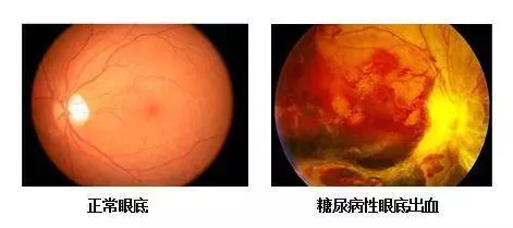 醫生告誡:「10個警示癥狀」一旦出現,可能就是「糖尿病」找上你...早發現早救命!
