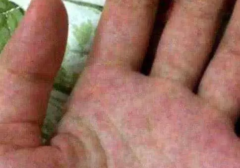 肝癌不痛不癢?但發現已是晚期,多留意手上這3種症狀,就能救你的命!
