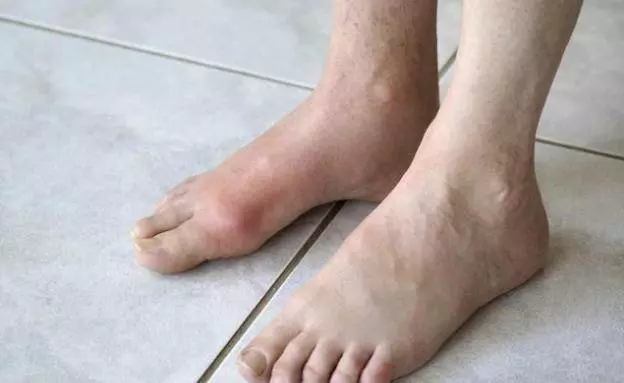 家有痛風病人,常備一子二根二葉,不擔心半夜痛醒!