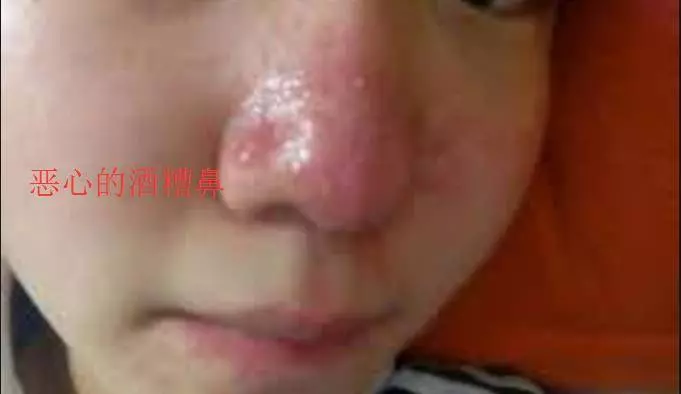 濕熱纏身,再也不用看醫生了,在家煮這種茶喝,效果非常好!