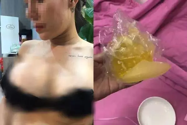 女子花1.4萬整形,坐了一趟飛機後沒想到「爆了」!