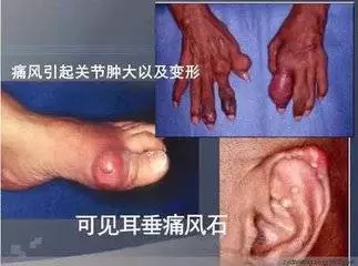 治尿酸秘方, 請轉發幫助更多人
