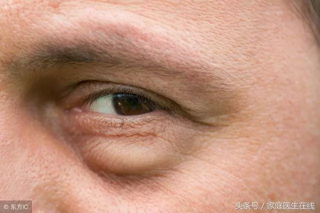 眼袋顯老又顯丑?學會這5招,輕鬆消眼袋,還不用花錢!
