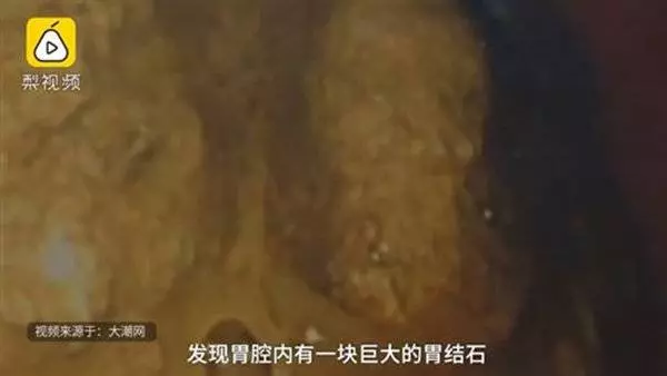 吃柿子長巨大胃結石 醫生要他「喝一周可樂」
