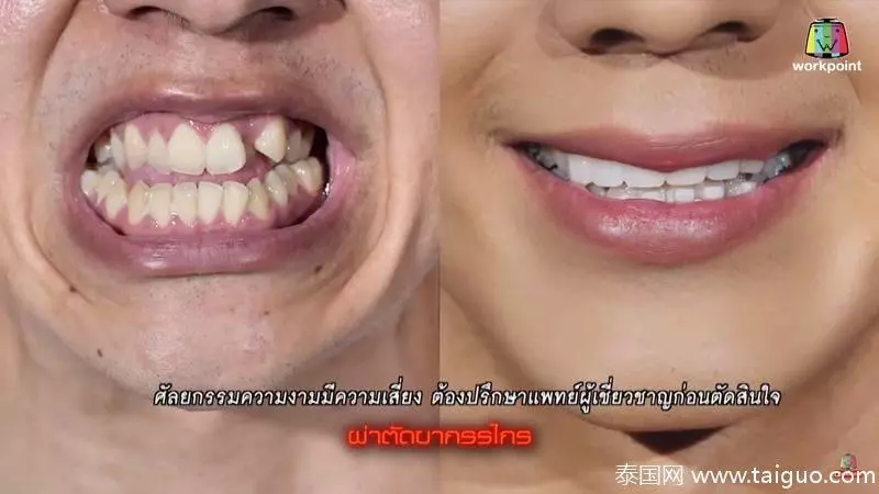 泰國整容真人秀醜男整容變歐巴!內附視頻