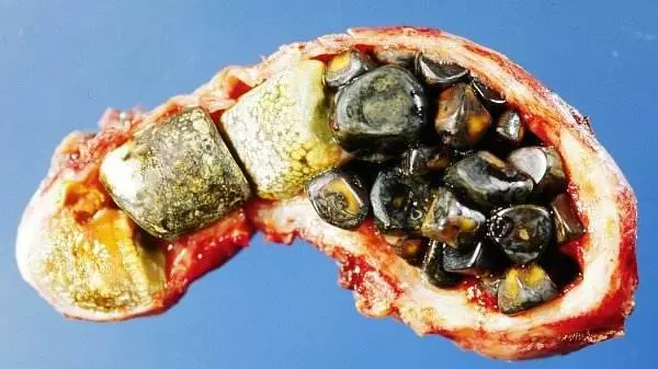 7天內能排出體內幾十顆「膽結石」!每個人都有!嘗試後整個人神清氣爽!