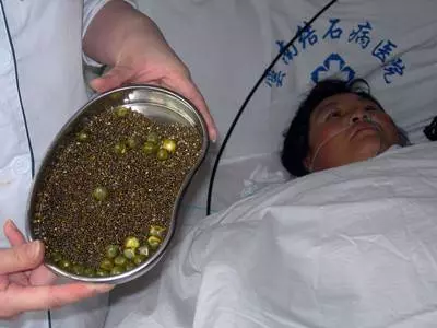 7天內能排出體內幾十顆「膽結石」!每個人都有!嘗試後整個人神清氣爽!